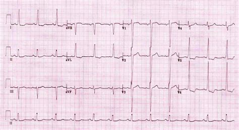 left ventricular hypertrophy life in the fast lane.